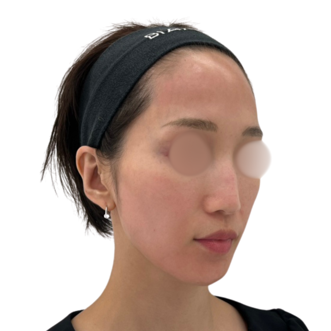 ピコフォーカス（ピコトーニング＋ピコフラクショナル）